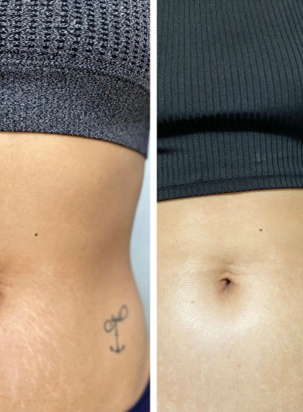 Antes e Depois Estrias 3